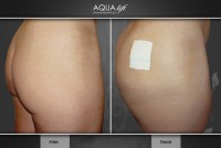 /album/galeria-de-fotos-antes-depois/aqualift-corporal-gluteos-1-jpg/