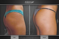/album/galeria-de-fotos-antes-depois/aqualift-corporal-gluteos-2-jpg/