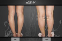/album/galeria-de-fotos-antes-depois/aqualift-corporal-panturrilhas-hidrogel-poliamida-jpg/
