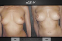 /album/galeria-de-fotos-antes-depois/aqualift-corporal-seios1-hidrogel-poliamida-jpg/