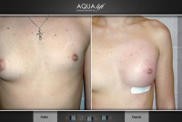 /album/galeria-de-fotos-antes-depois/aqualift-corporal-seios-assimetria-jpg/