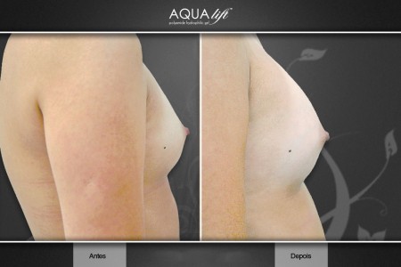 AQUA lift